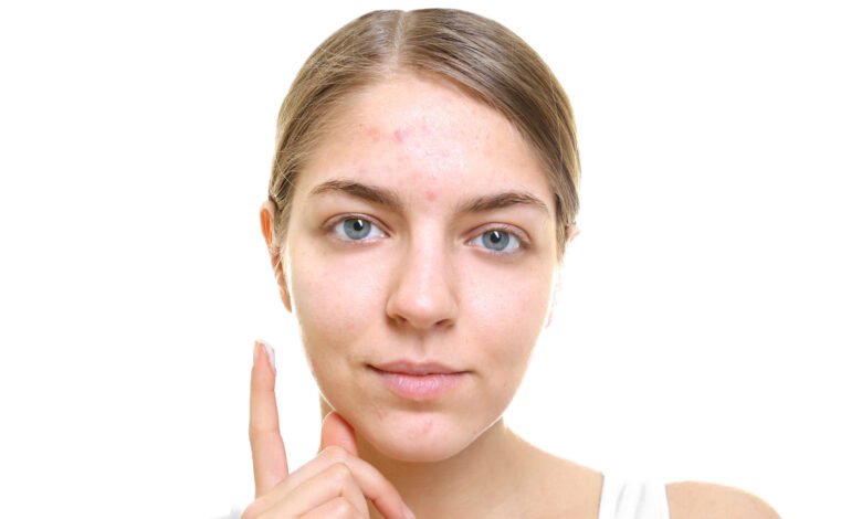 acne removal products