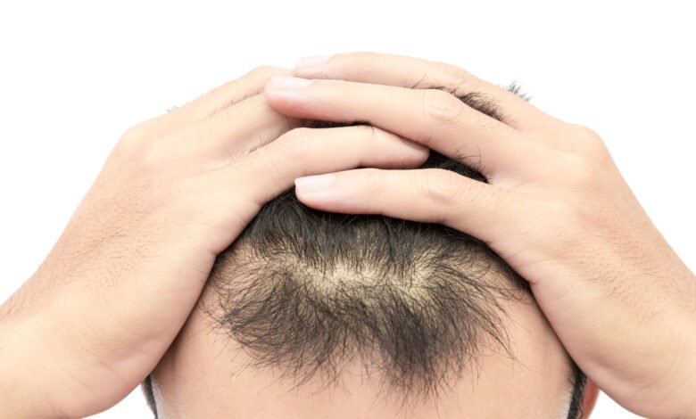 hair transplant surgery