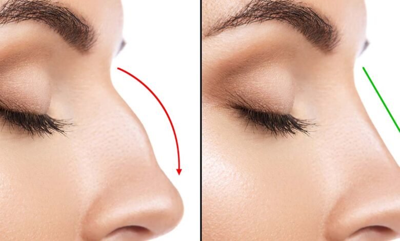 Rhinoplasty