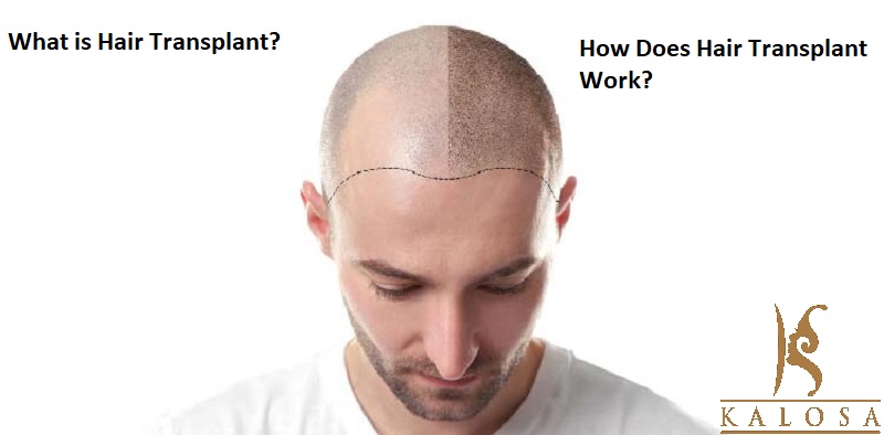 hair transplant