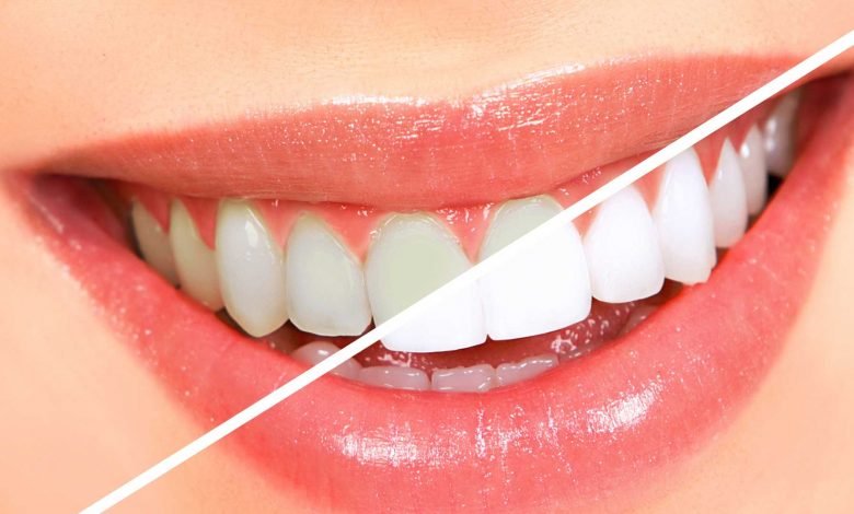 Teeth Whitening