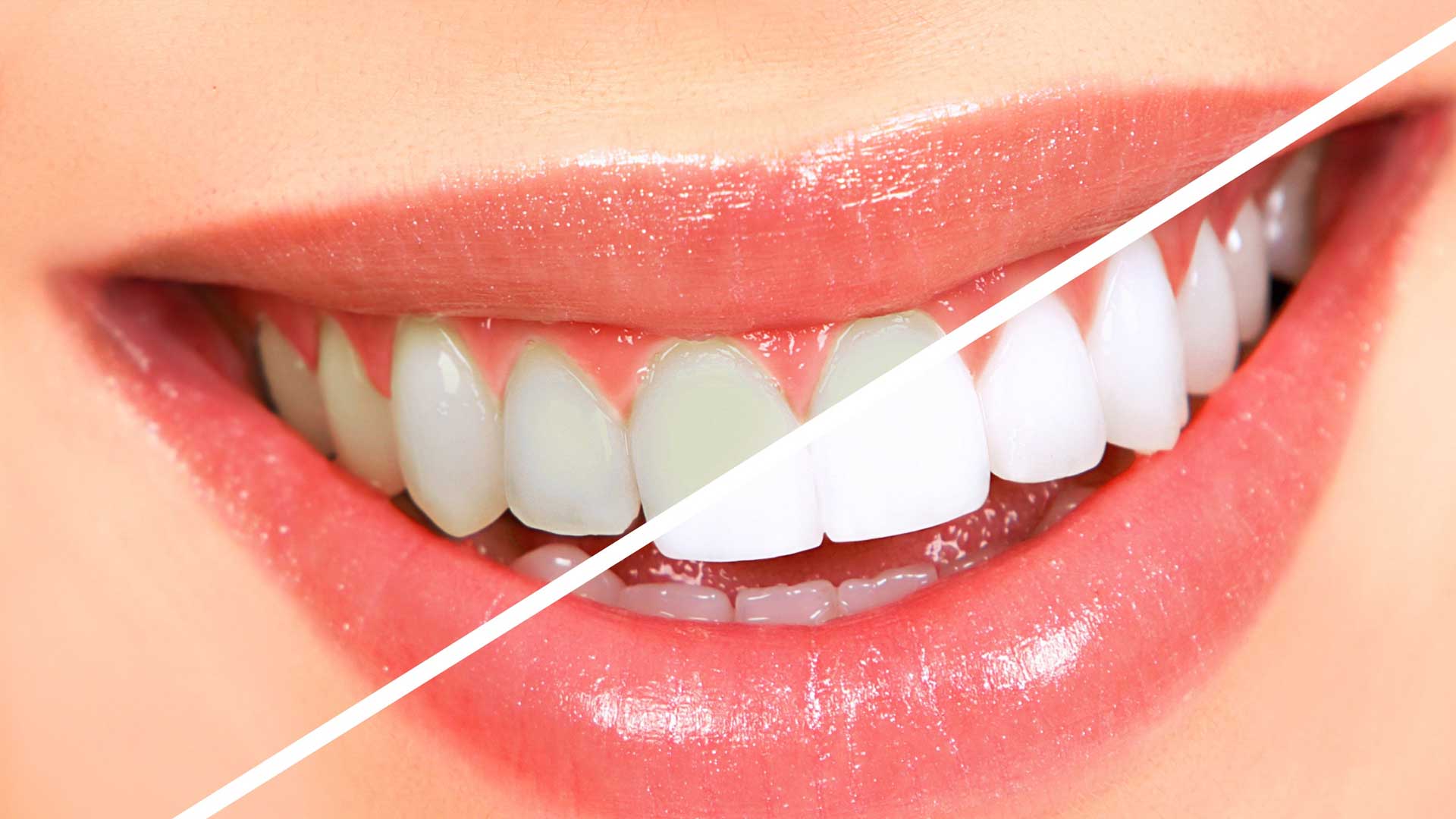 Teeth Whitening